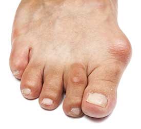 Bunions Treatment in Southlake, TX